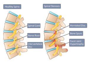 Spinal stenosis